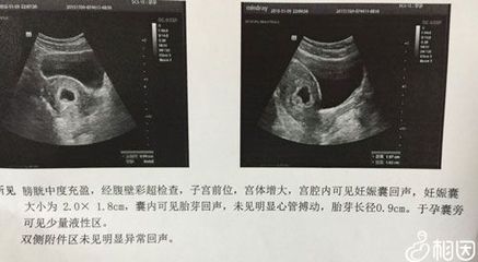 怀孕35天能看到孕囊吗