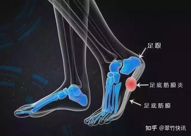 足底筋膜炎怎么治疗