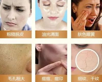 痘痘男護膚哪個好