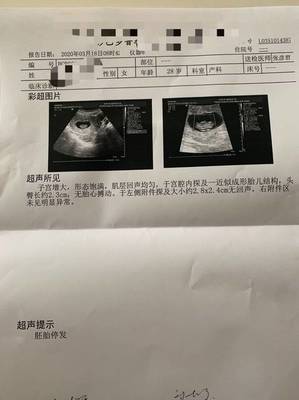 两个月没有胎心