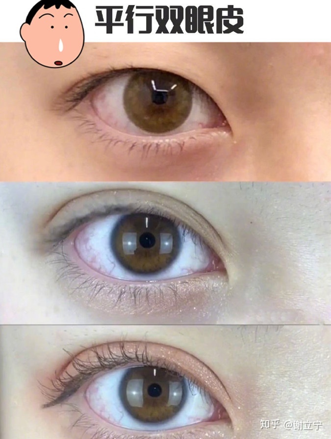 好看的内眦双眼皮