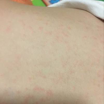 孩子背上起痘痘是怎么回事