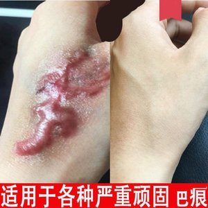红色痘痘疤痕怎么消除