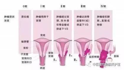 宫颈肿瘤怎么治疗