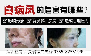 白癜风该怎么治疗好