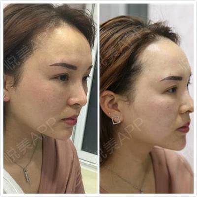 纹眉后里面有痘痘