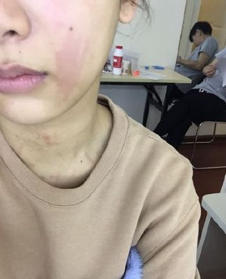 护肤品用了几天才过敏