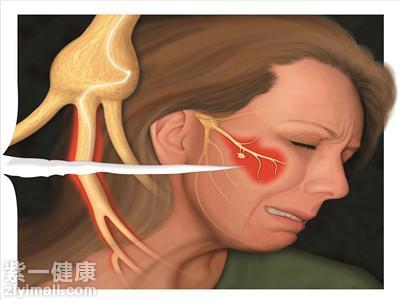 口腔神经痛的症状