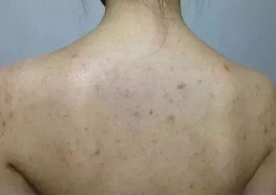 男人背上长痘痘用什么洗