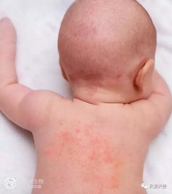 宝宝身上起痱子图片