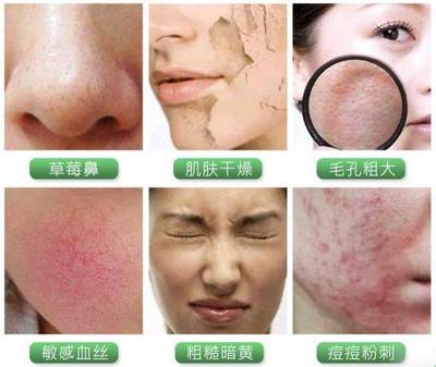 熬夜的痘痘用什么护肤品