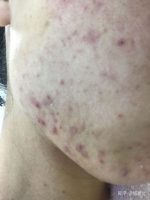 长痘痘去看皮肤科