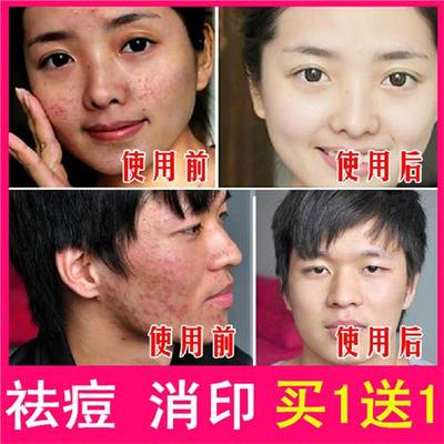 皮肤专家消除痘痘