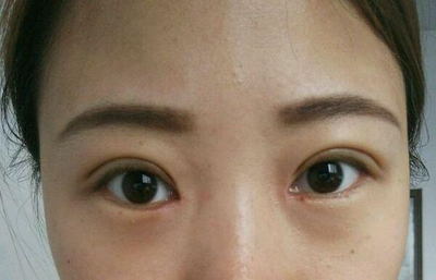 双眼皮上长了个脂肪粒