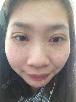 双眼皮抽线怎么抽