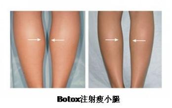 打botox瘦腿针效果好不好