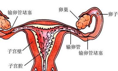 多囊会影响怀孕吗