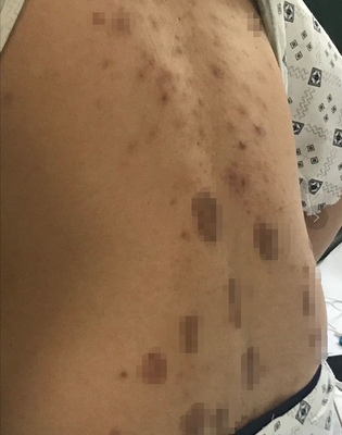 满背痘痘怎么办