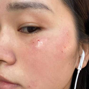 激光点肉痣