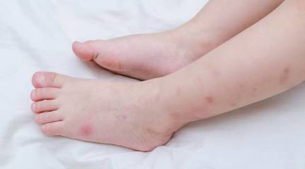痘痘可以不处理嘛