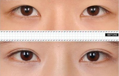 开双眼皮后遗症