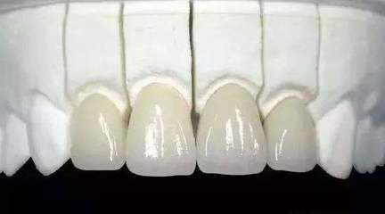 贵金属烤瓷牙的危害