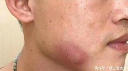 为什么脸上有痘痘男士