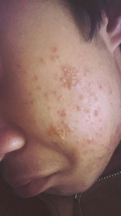 痘痘结痂凹陷