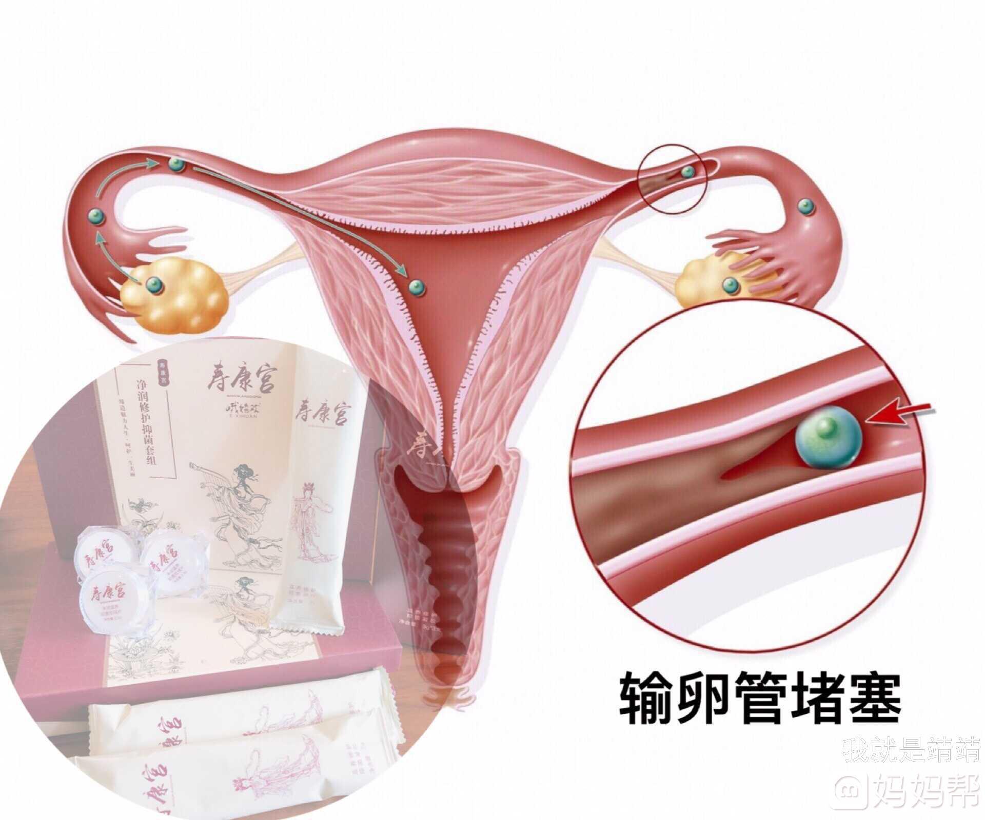 输卵管不通是怎么回事
