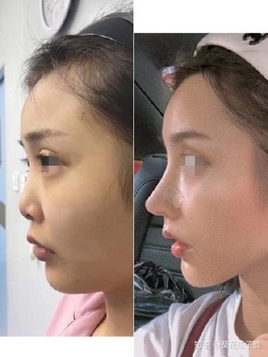隆鼻效果怎么样
