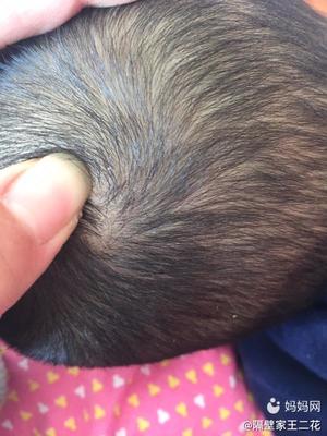 小孩起头皮屑是怎么回事
