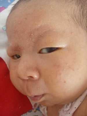 怎么除额头上痘痘