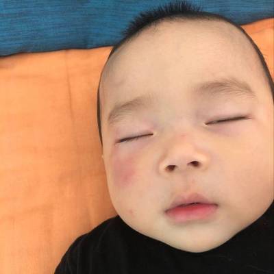 宝宝脸摔青了怎么办