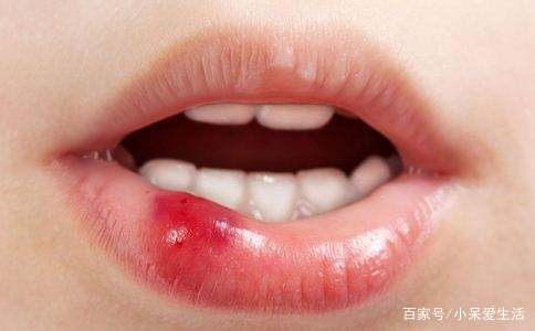 口腔黏膜溃疡怎么治疗