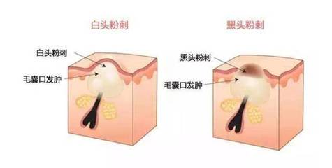 闭口粉刺很深发不出来