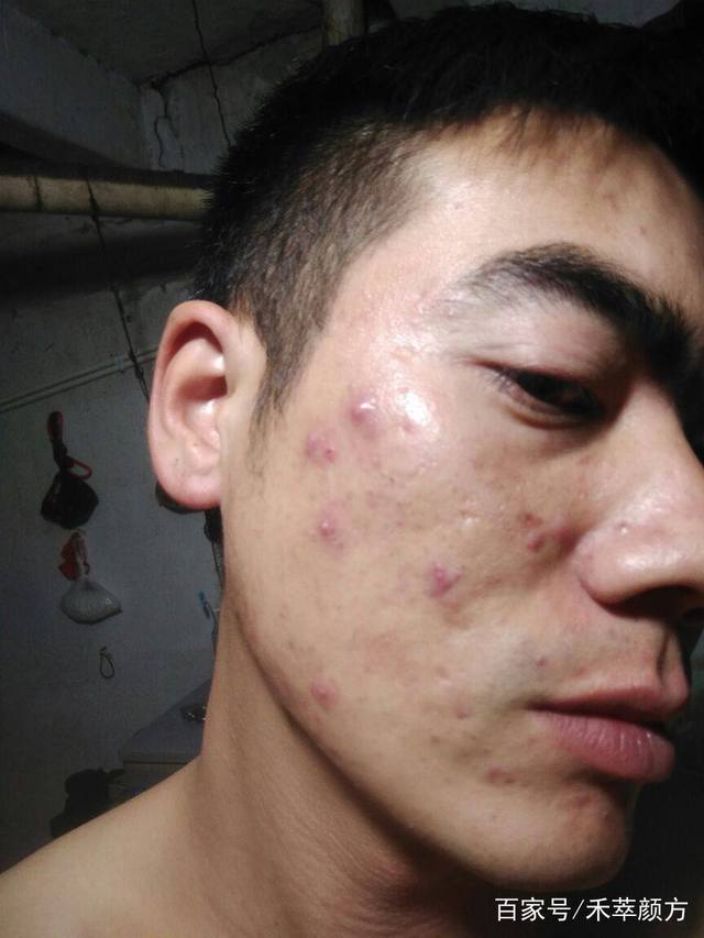 男士脸上长痘痘是什么原因
