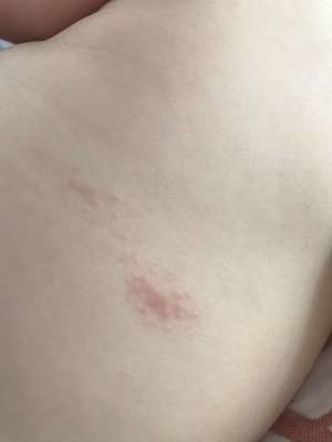 后背受潮起痘痘