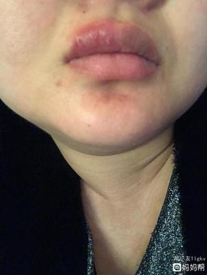嘴巴上面的痘痘疼