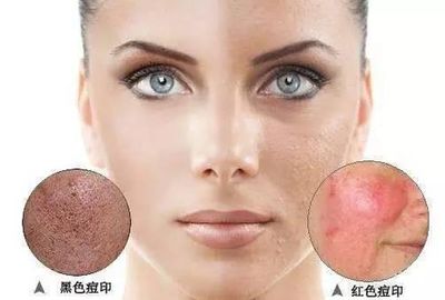 脸上黑色痘印怎么去除