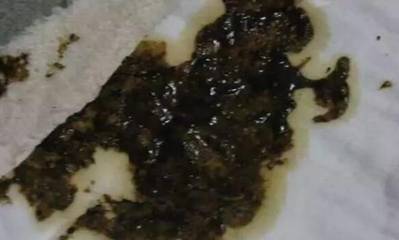 一岁宝宝拉黑色大便怎么回事