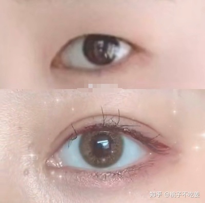 双眼皮割的太窄了