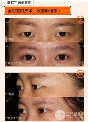 薛红宇双眼皮案例