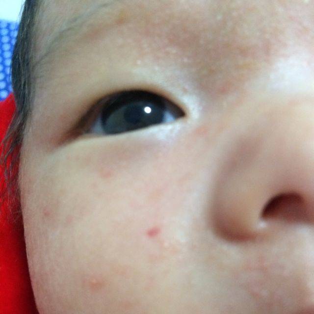 宝宝眼周围小红点图片