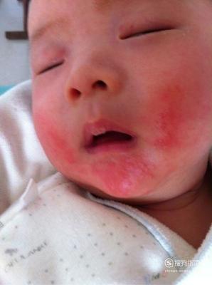 6个月宝宝出疹子症状