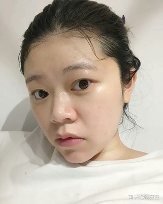 痘印会自动消失吗