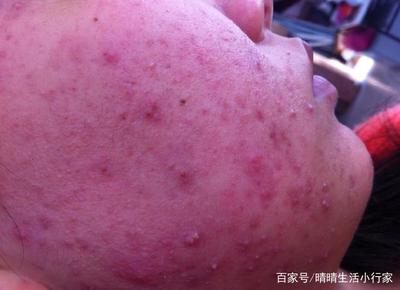 怎么预防炎症痘痘