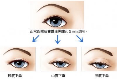 眼部提肌无力怎么解决