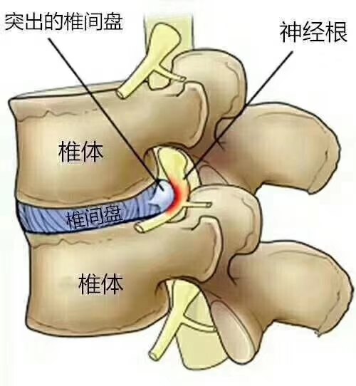 腰椎盘突出属于什么科