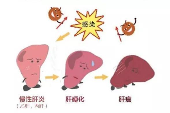 肝炎怎么治疗最好的方法