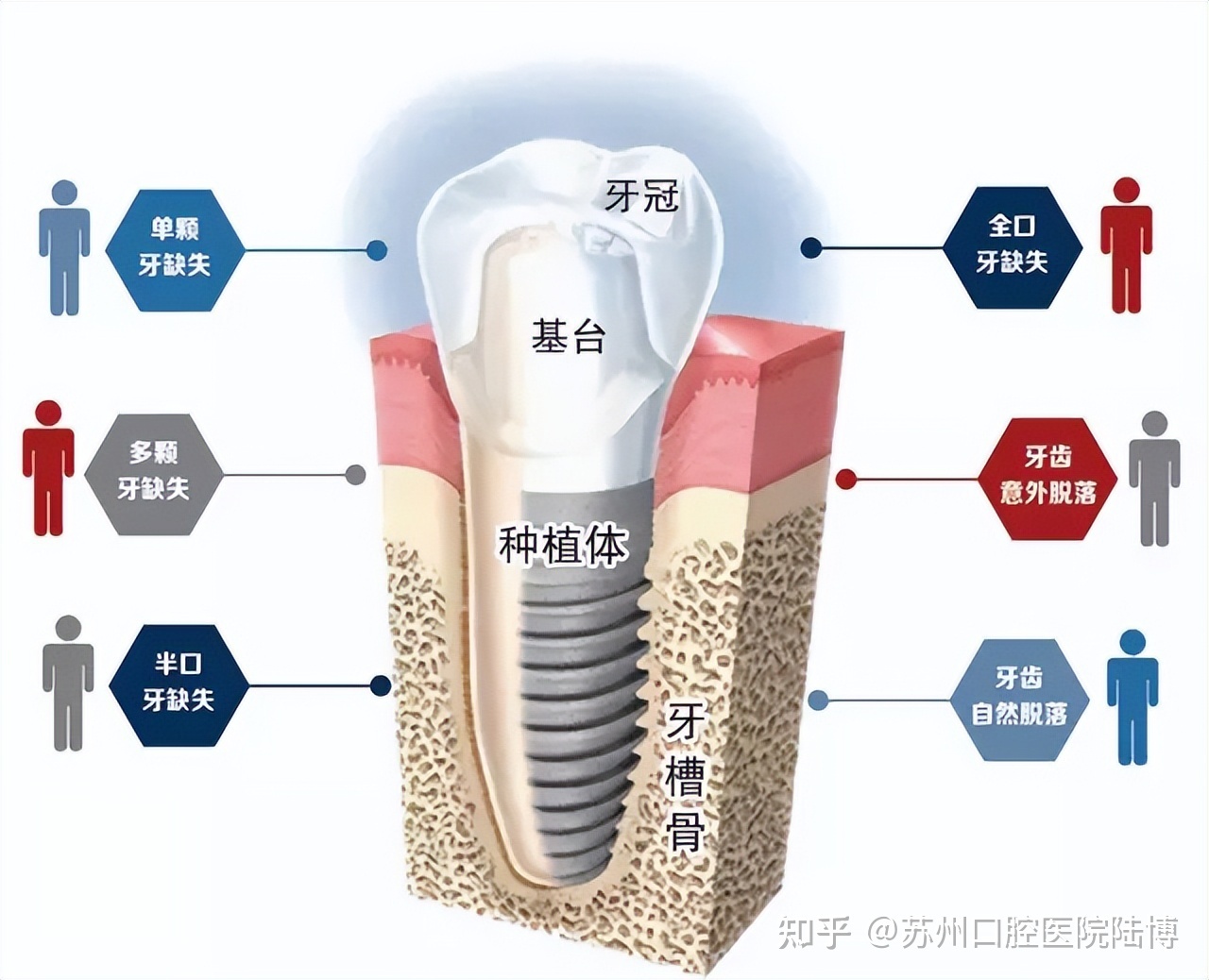 种牙的原理